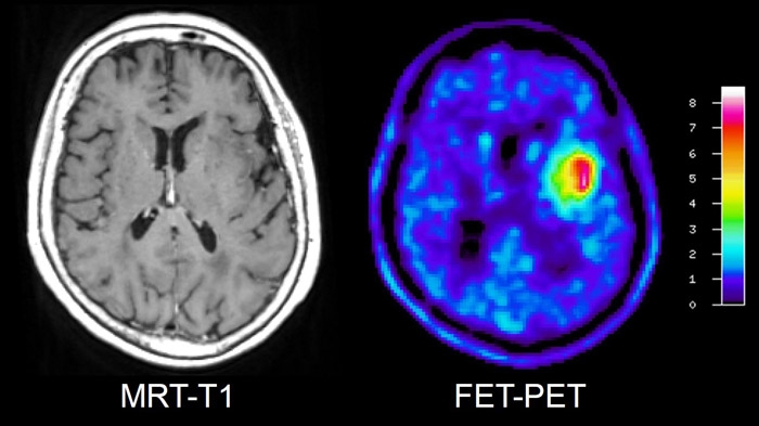 Il est très difficile de délimiter la tumeur cérébrale dans le cadre d’un IRM en pondération T1 après injection du produit contraste (gauche). La FET-TEP permet de représenter la tumeur sous la forme d’une zone de métabolisme actif (coloration rouge-jaune).